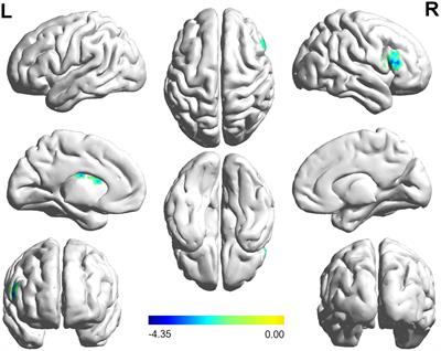 Altered Brain Functional Connectivity at Resting-State in Patients With Non-arteritic Anterior Ischemic Optic Neuropathy